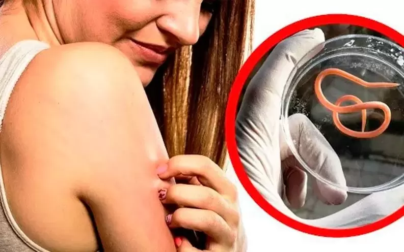 зуд и раздражение при паразитах в организме